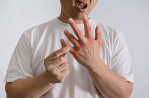 Cara Mencegah Asam Urat Kambuh di Musim Lebaran