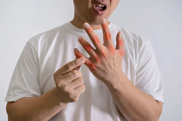 Cara Mencegah Asam Urat Kambuh di Musim Lebaran